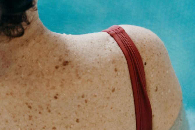 Post-Summer Skin Checks: Why It’s Worth Booking Your Mole Check